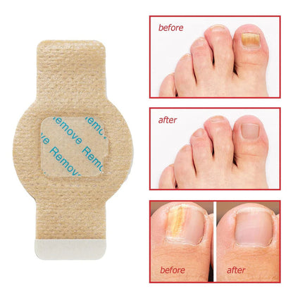 Fungal Nail Patches