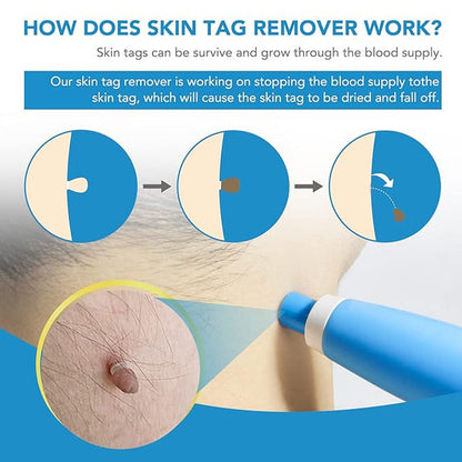 Skin Tag Remover Kit with 40 Bands