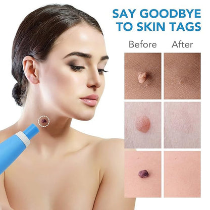 Skin Tag Remover Kit with 40 Bands